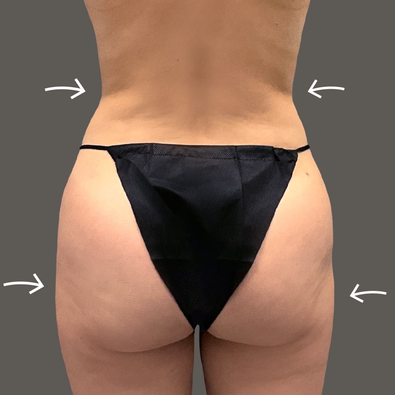 Ariana after airsculpt