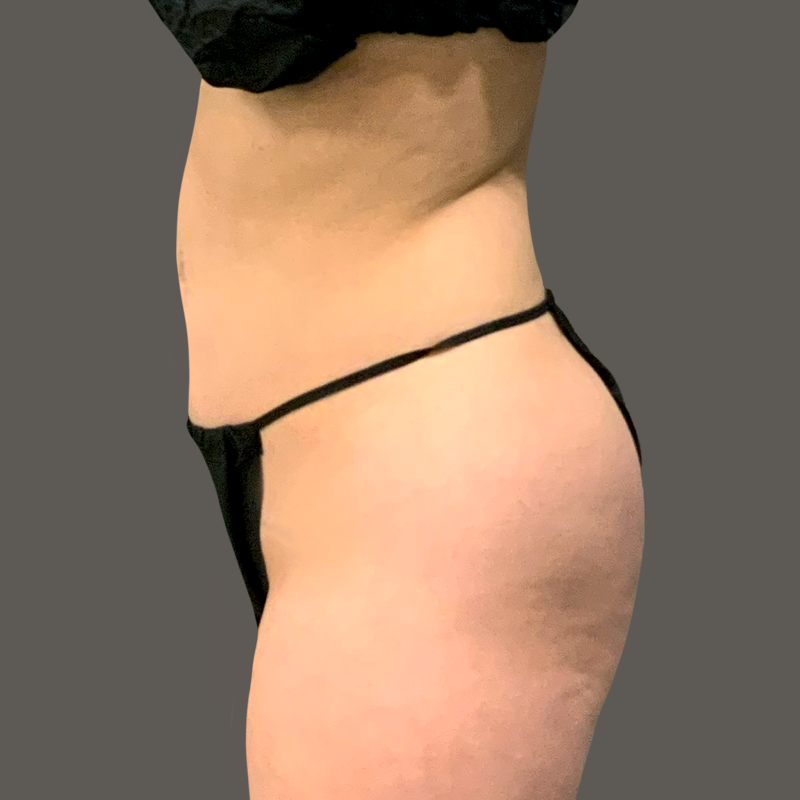 Ariana Before Airsculpt