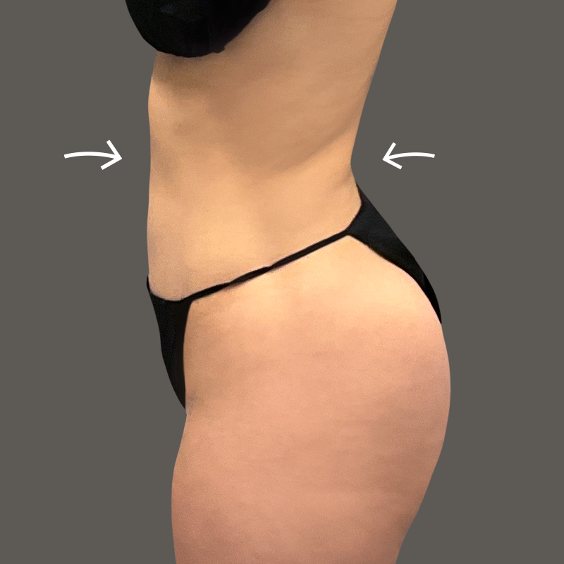 Ariana after airsculpt