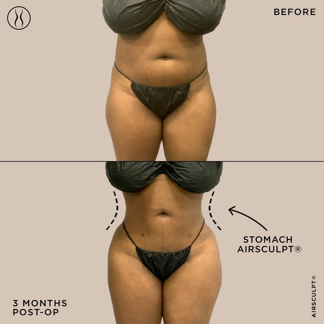 before and after photo of stomach liposusction with AirSculpt, with small scars to show