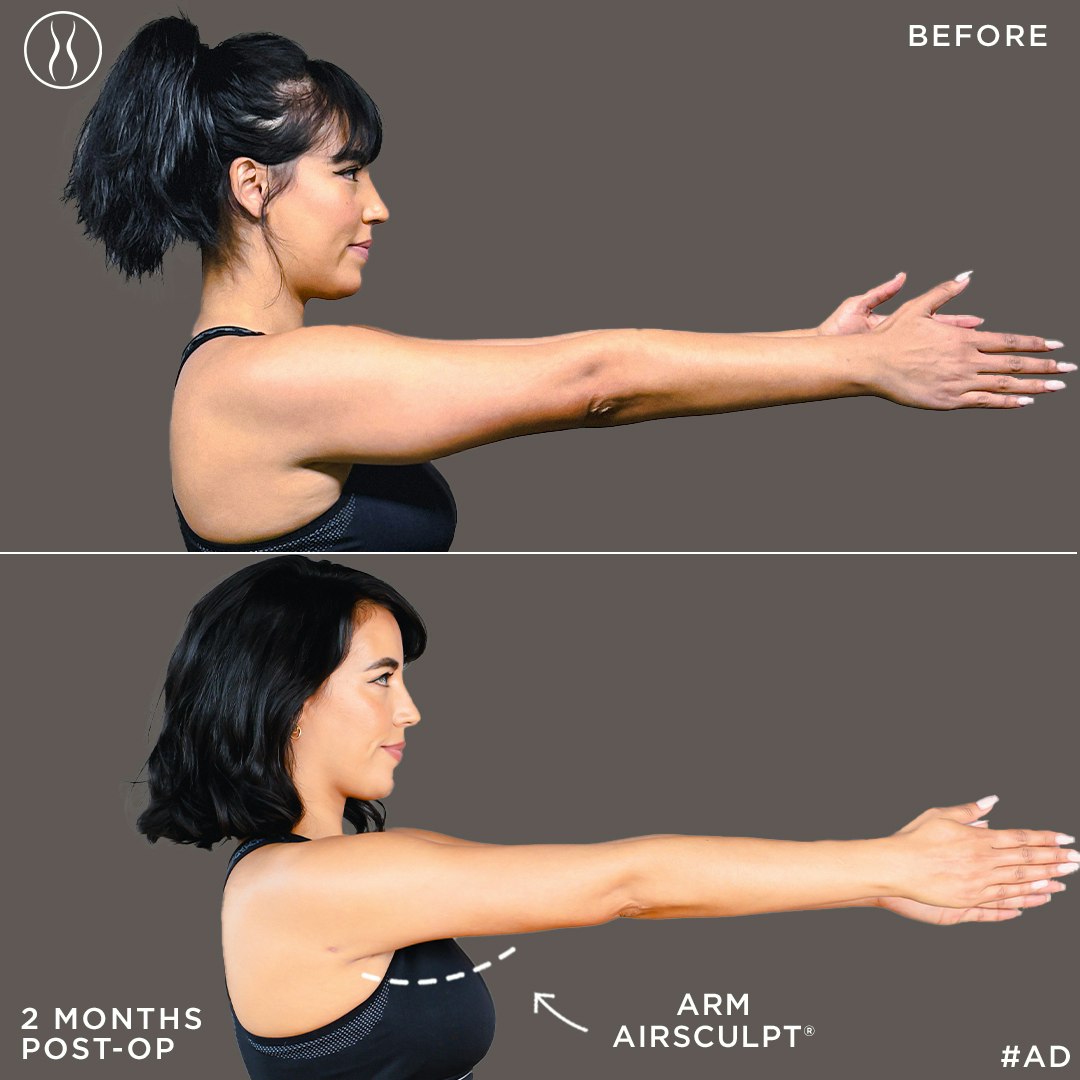 Arm Liposuction Scars What Are They Like And How Do They Compare With Arm Liposuction Scars What Are They Like And How Do They Compare With