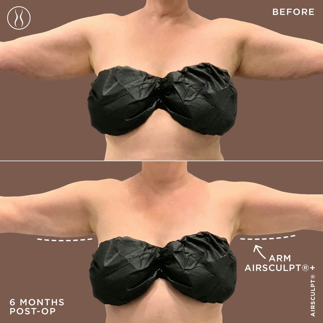 Renuvion skin tightening before and after image: 6-month post-op, Arm AirSculpt+ procedure label with arrow pointing at the after image