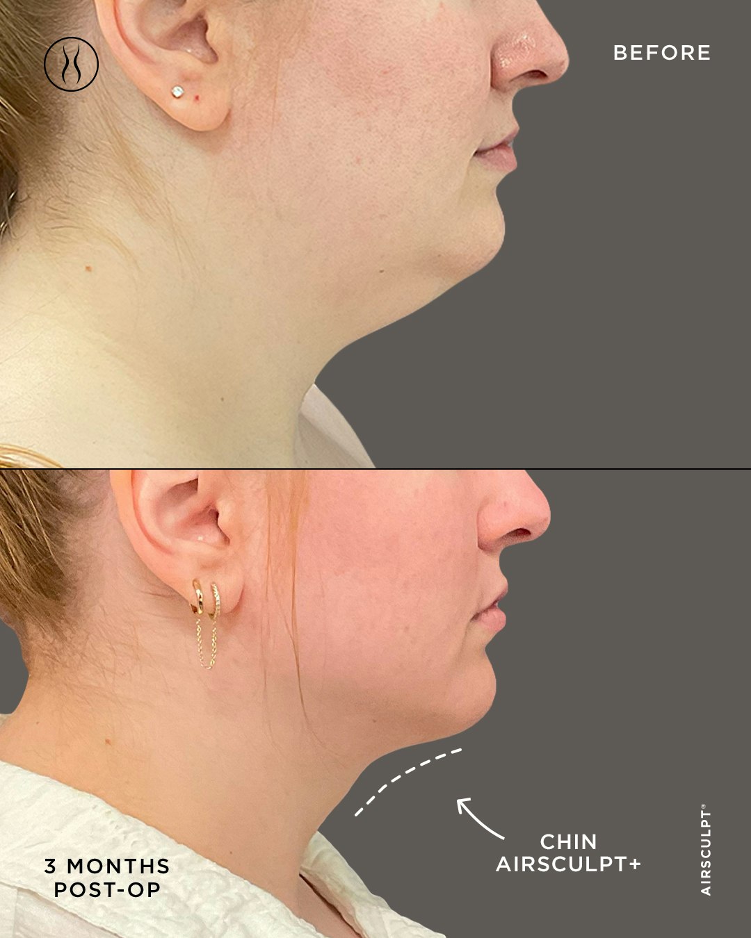 Renuvion skin tightening before and after image: 3-month post-op, Chin AirSculpt+ procedure label with arrow pointing at the after image