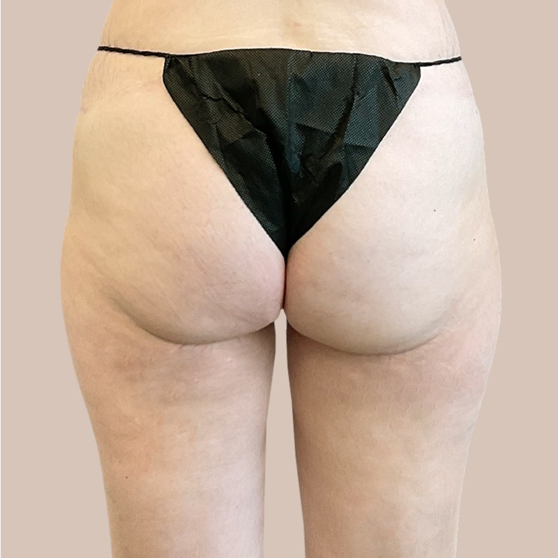 inner thighs before airsculpt