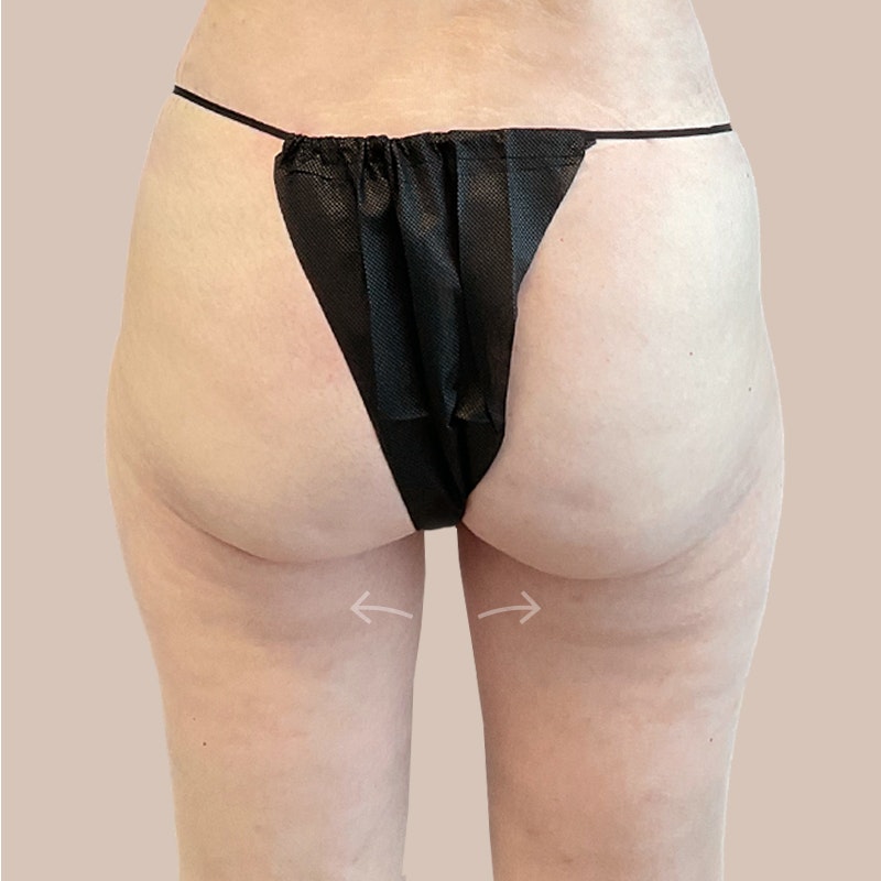 inner thigh after airsculpt