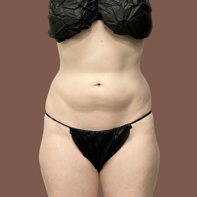 stomach and hip after airsculpt