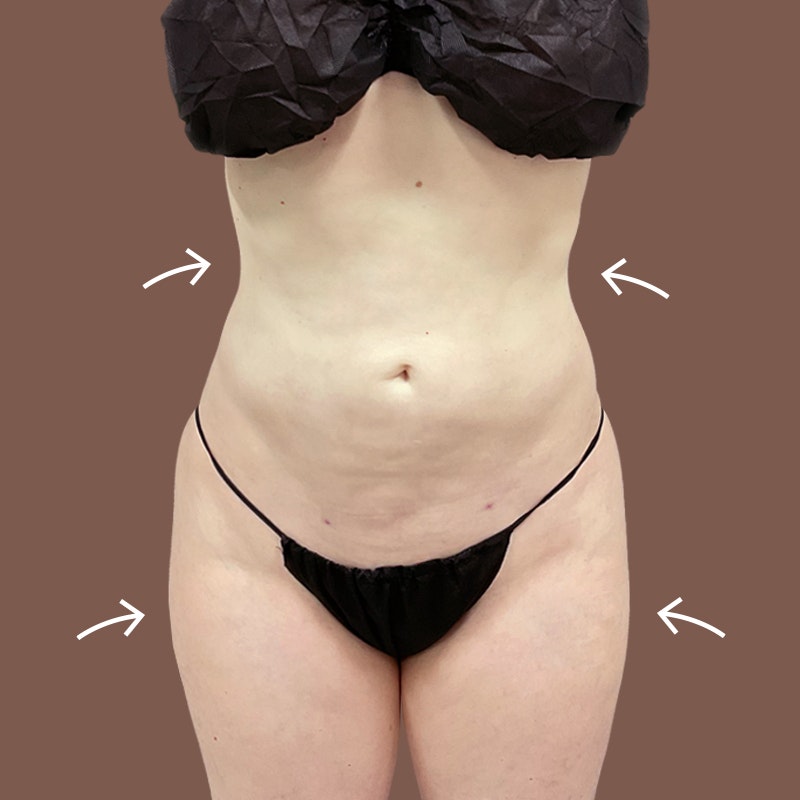 stomach and hip after airsculpt