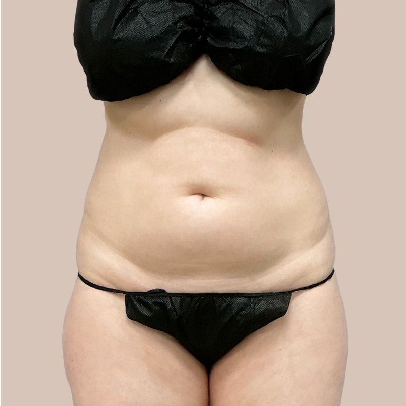 stomach before airsculpt