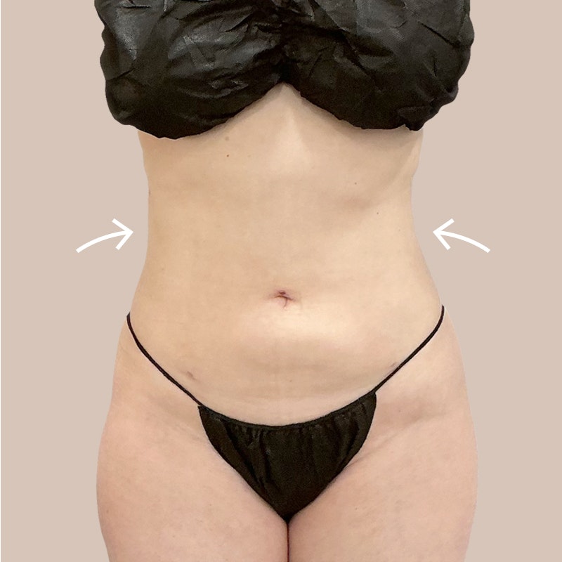 stomach after airsculpt