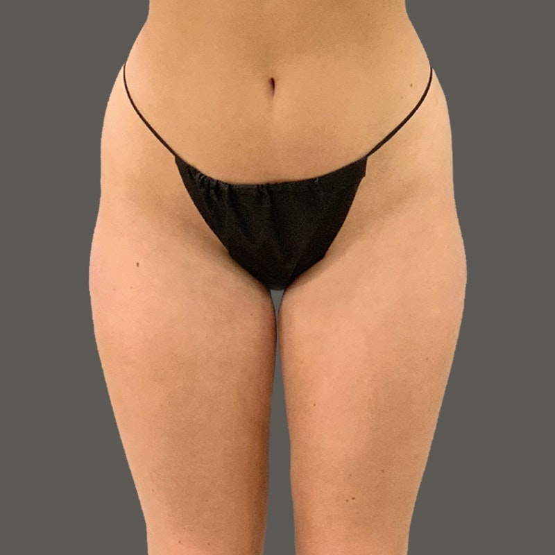 before airsculpt hipflip