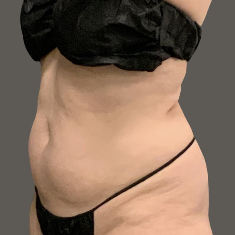 Woman stomach and back before airsculpt