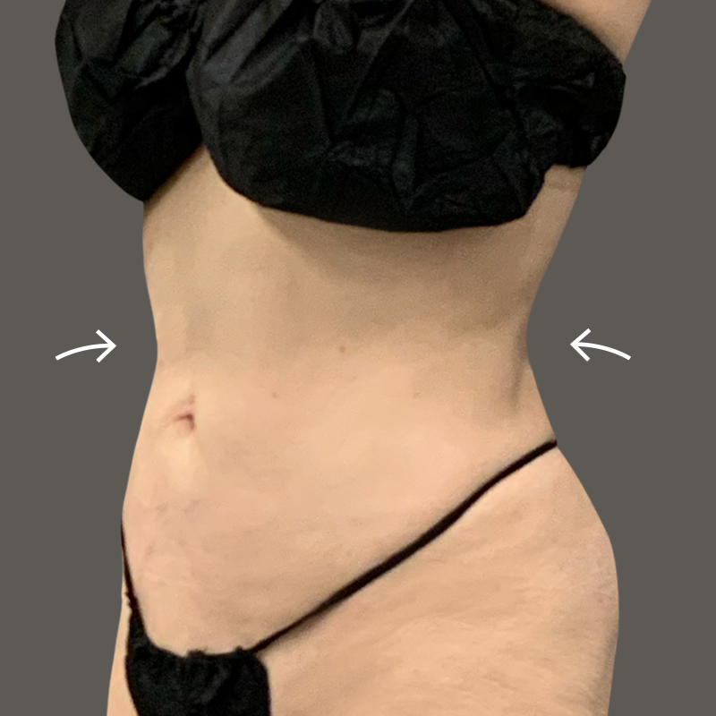 Woman stomach and back after airsculpt