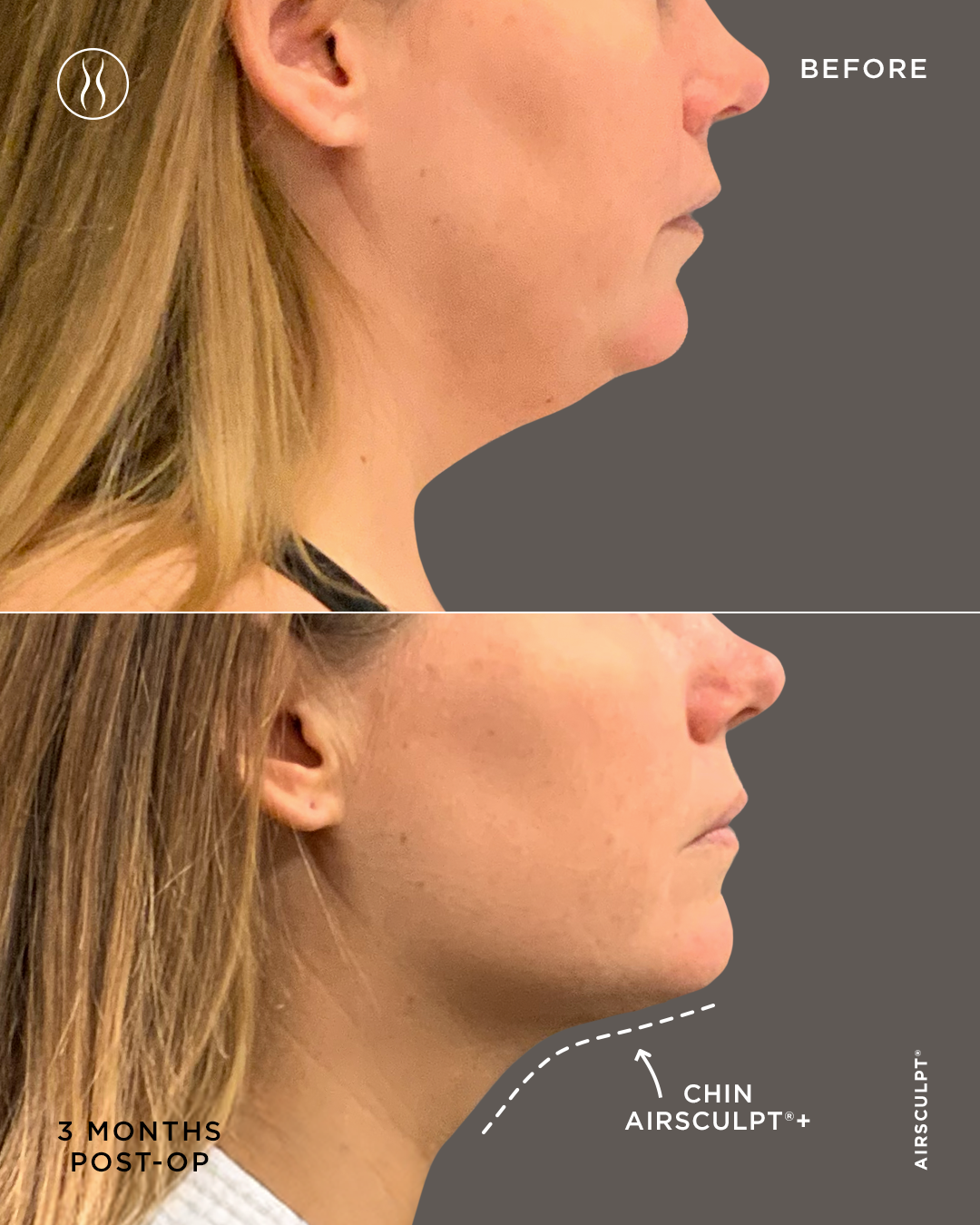 Chin AirSculpt+ three month before and after double chin reduction