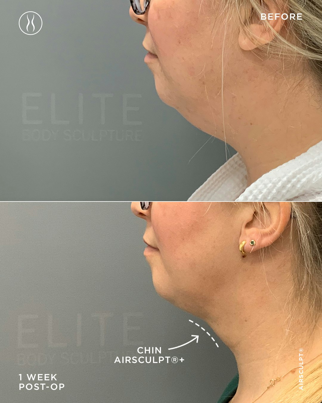 final result before and after six months following Chin AirSculpt+