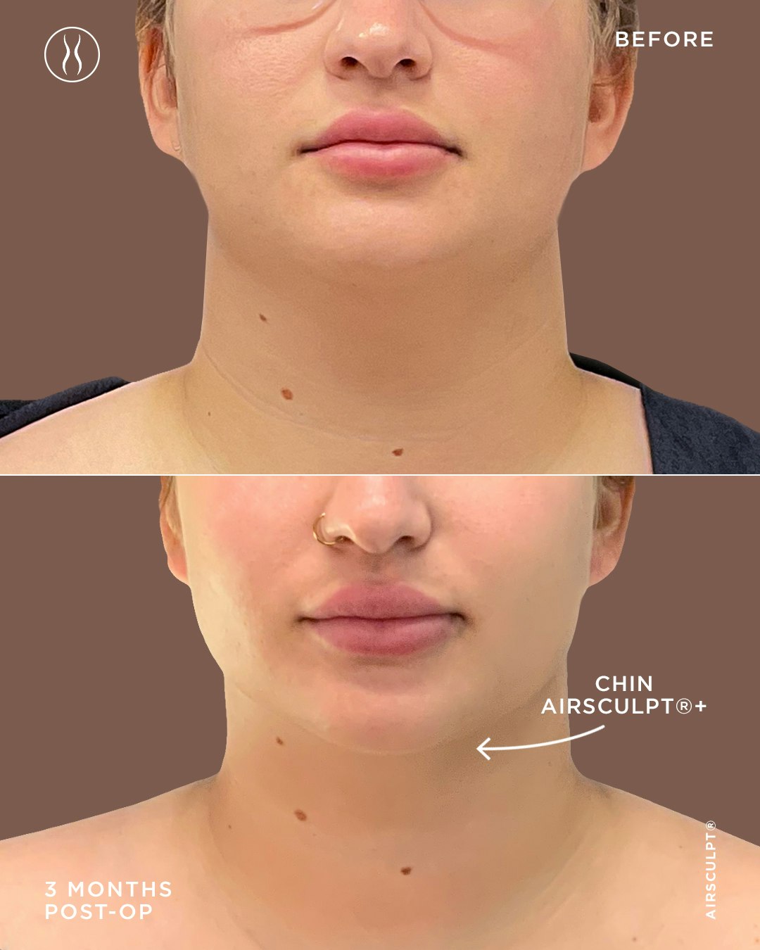 three month before and after Chin AirSculpt+ fat removal and skin tightening