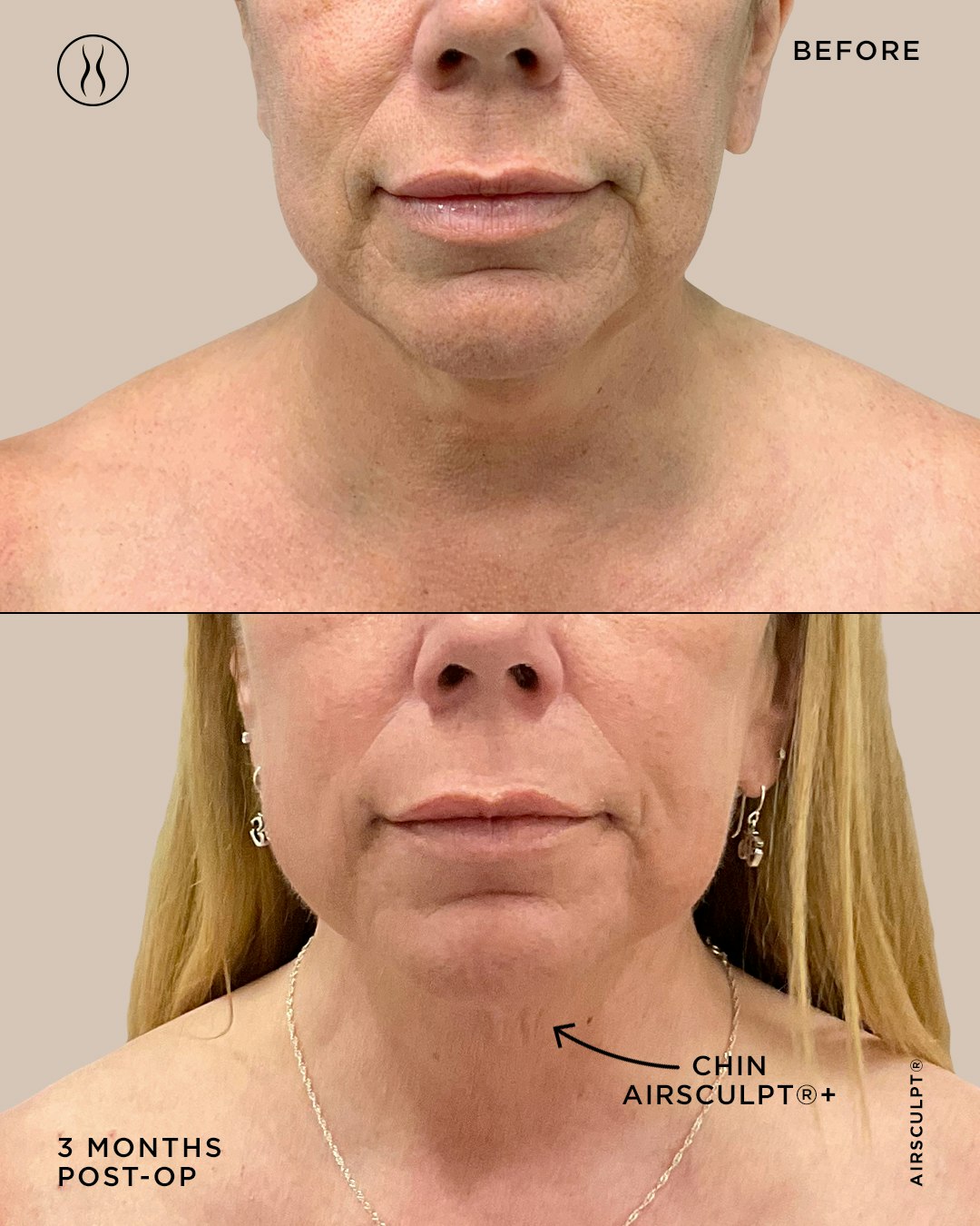 before and three months after Chin AirSculpt+ featuring an older patient with loose skin under her chin in the before