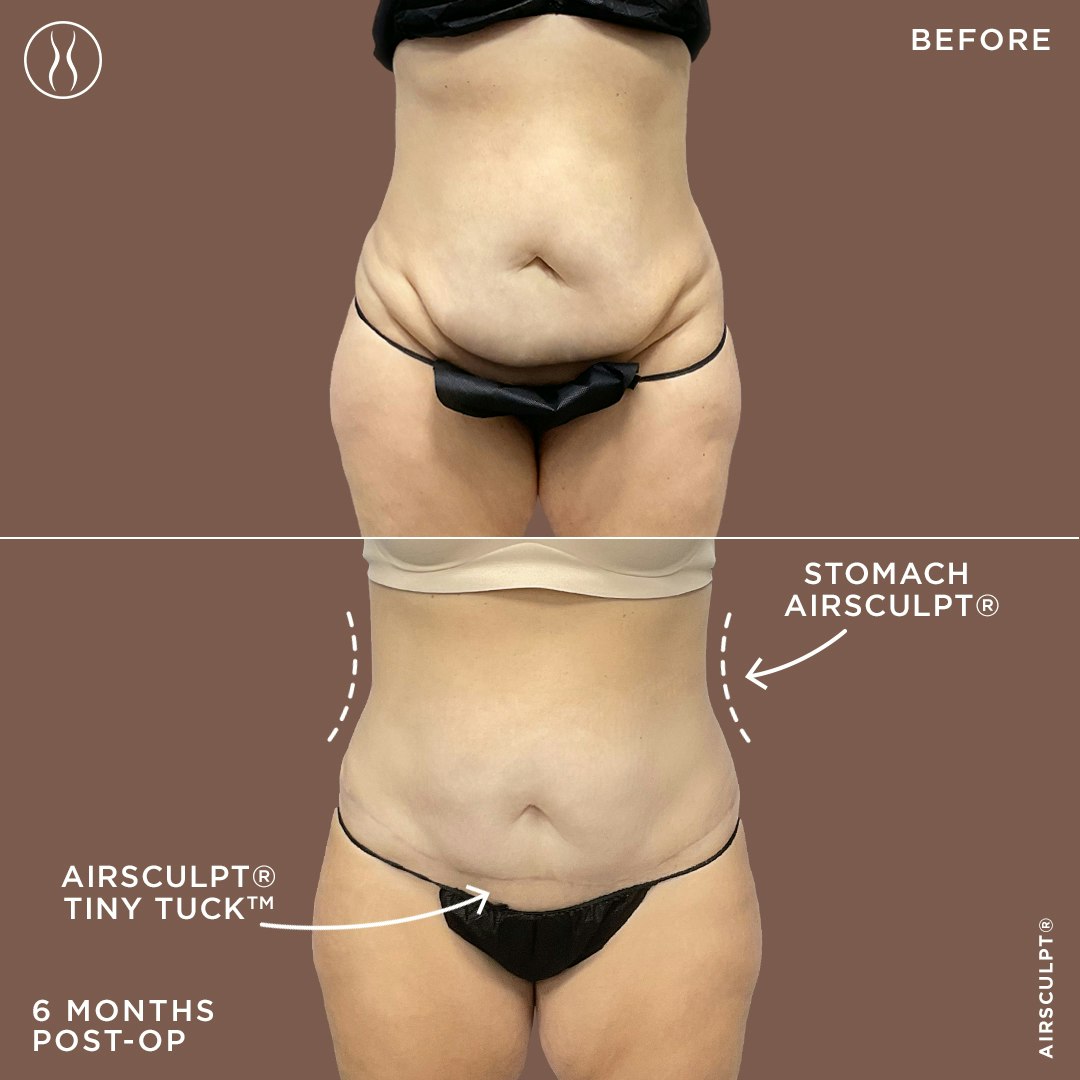 stomach airsculpt and tiny tuck before and after image – before on top featuring a hanging belly, after on bottom featuring a firm and flat stomach