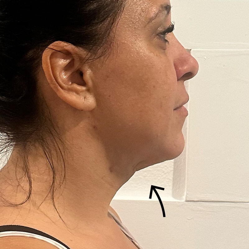 Chin After