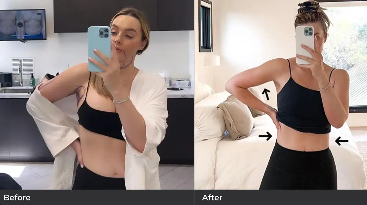 Before and after comparison of woman&rsquo;s midsection showing reduced waistline and improved contour after body sculpting procedure