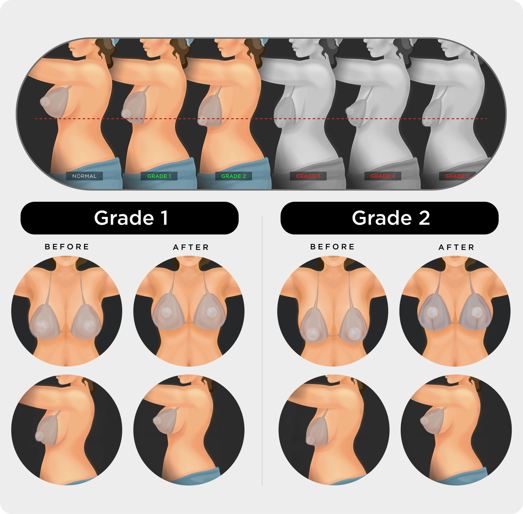breastlift chart