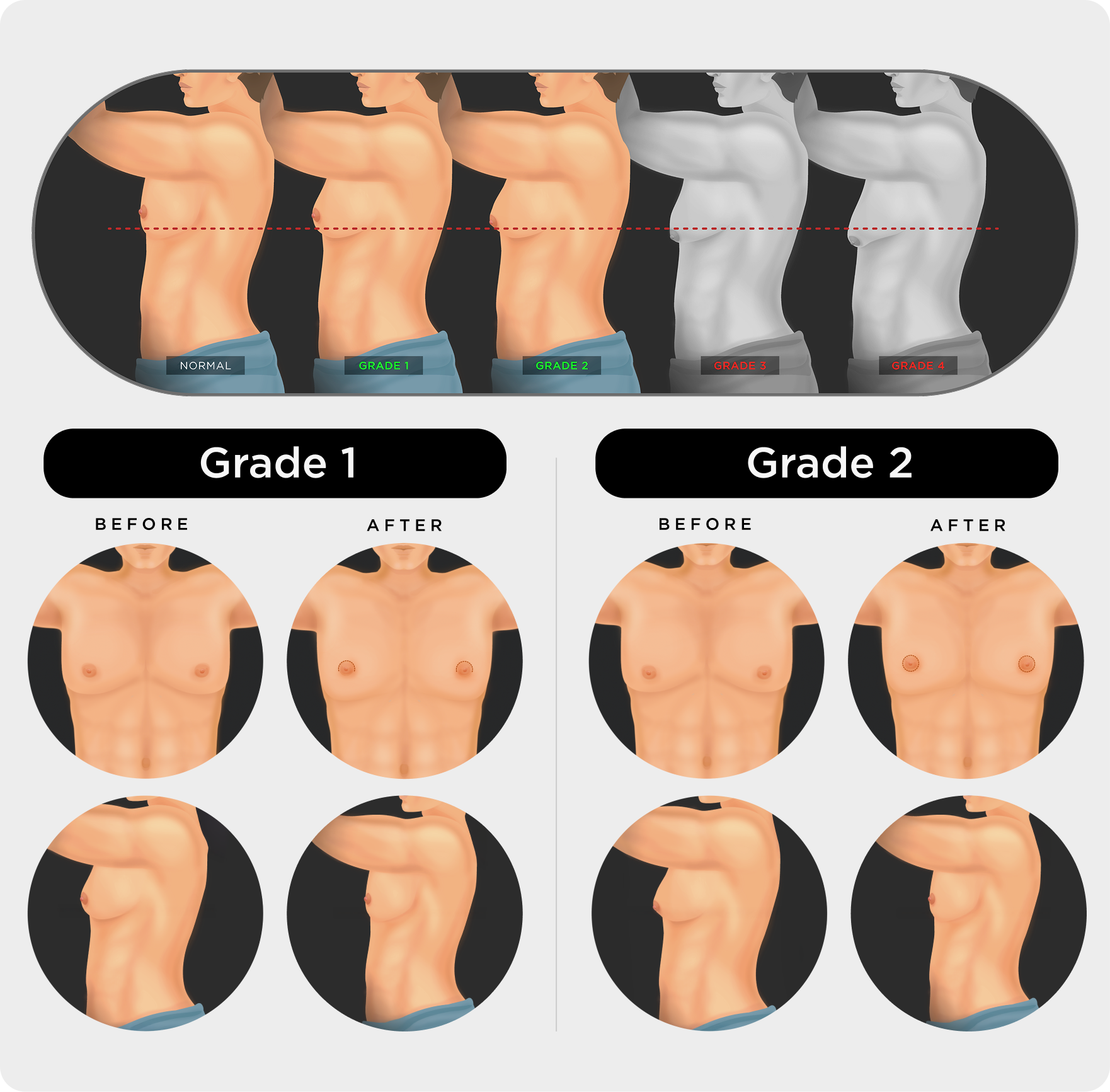 chestlift chart