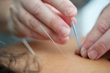 Does acupuncture hurt?
