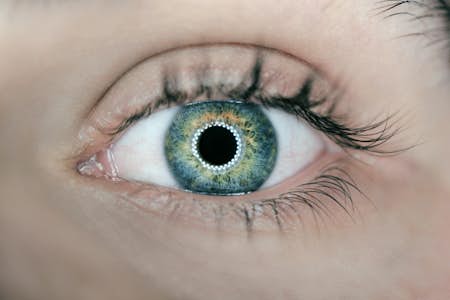 What is commonly misdiagnosed as pink eye?