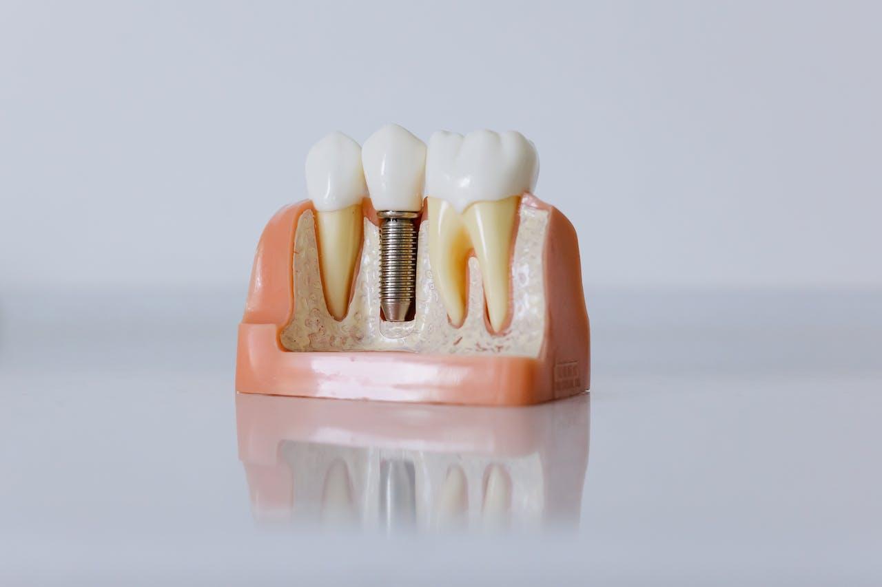 Does Medicare cover dental implants?