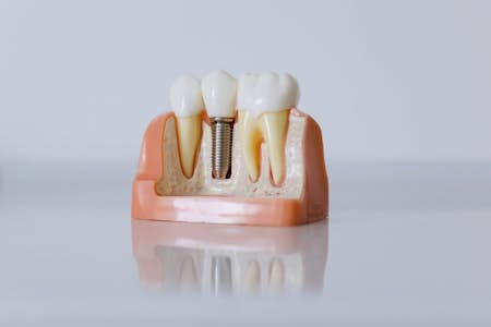 Does Medicare cover dental implants?