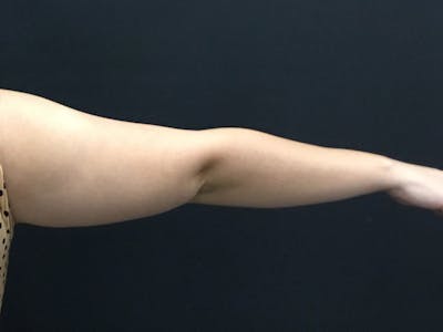 CoolSculpting Before & After Gallery - Patient 16689024 - Image 2