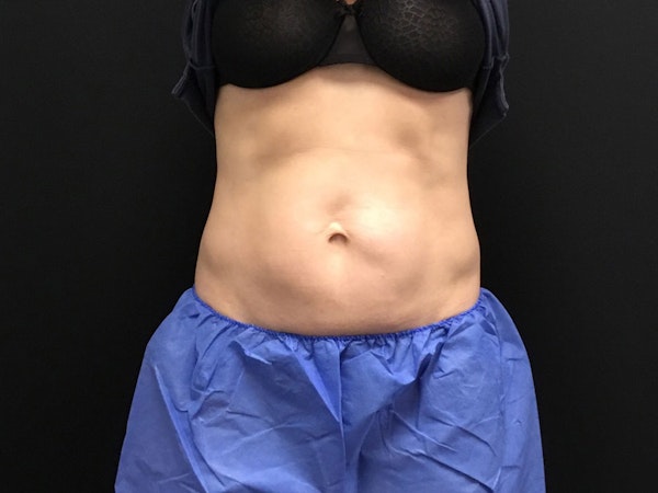 CoolSculpting