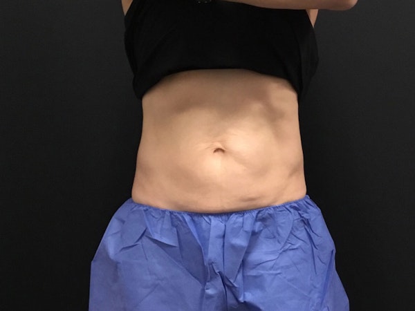CoolSculpting