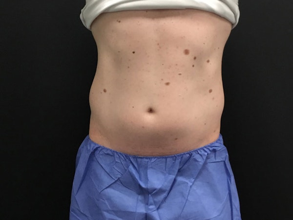 CoolSculpting in Tucson, AZ
