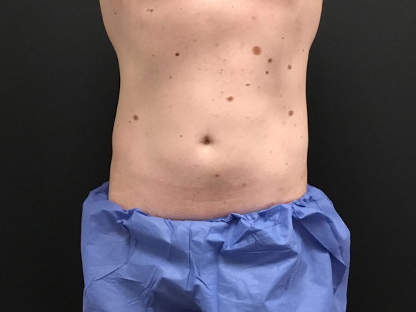 CoolSculpting in Tucson, AZ