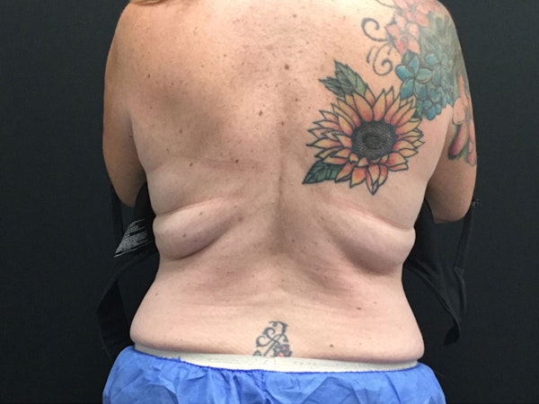 CoolSculpting