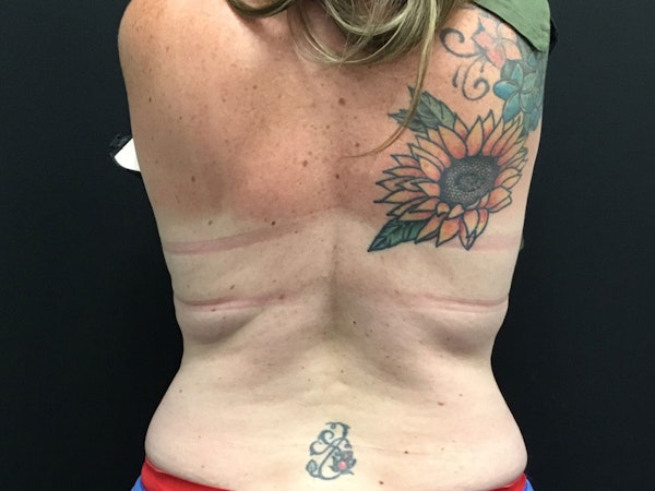 CoolSculpting