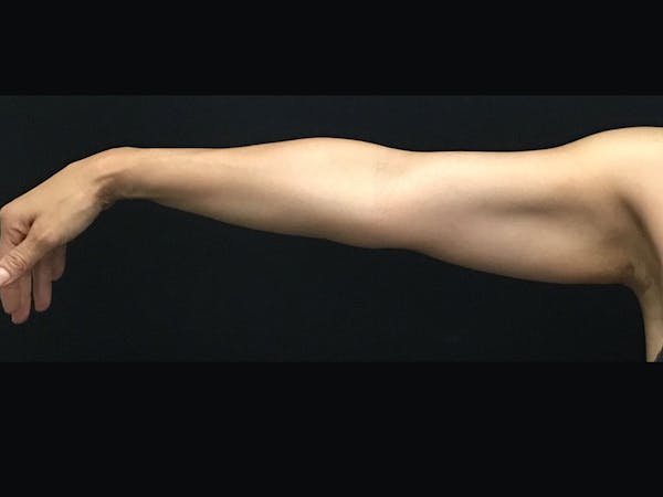 CoolSculpting Before & After Gallery - Patient 16689030 - Image 3