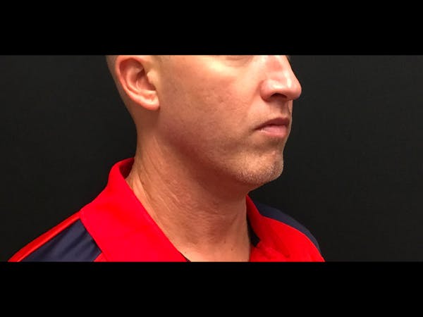 CoolSculpting Before & After Gallery - Patient 16689033 - Image 1
