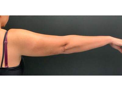 CoolSculpting Before & After Gallery - Patient 16689037 - Image 2