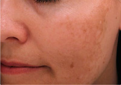 Skin Treatment Gallery - Patient 16689045 - Image 1