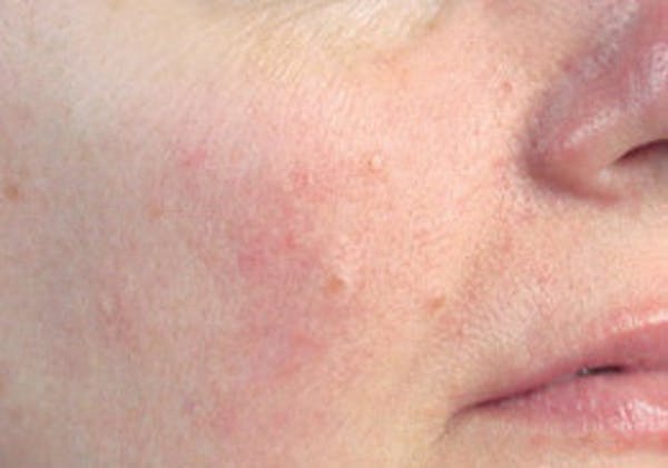 Skin Treatment Gallery - Patient 16689046 - Image 2