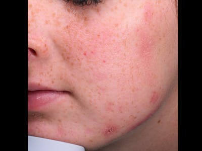 Skin Treatment Gallery - Patient 16689048 - Image 1