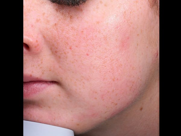Skin Treatment Gallery - Patient 16689048 - Image 2