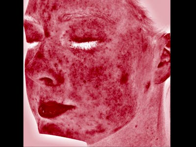 Skin Treatment Gallery - Patient 16689048 - Image 4