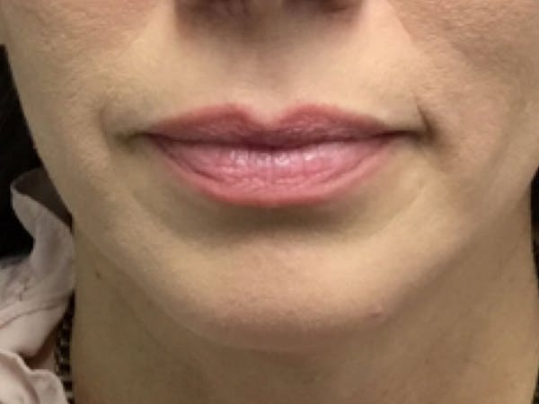 Filler Injections for Face Before & After Gallery - Patient 16689052 - Image 1