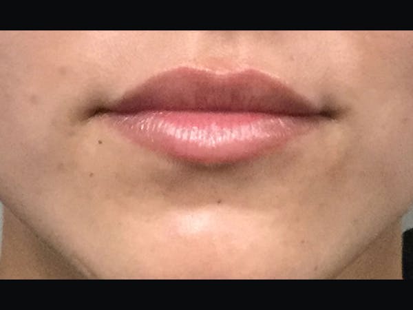 Filler Injections for Face Before & After Gallery - Patient 16689054 - Image 1