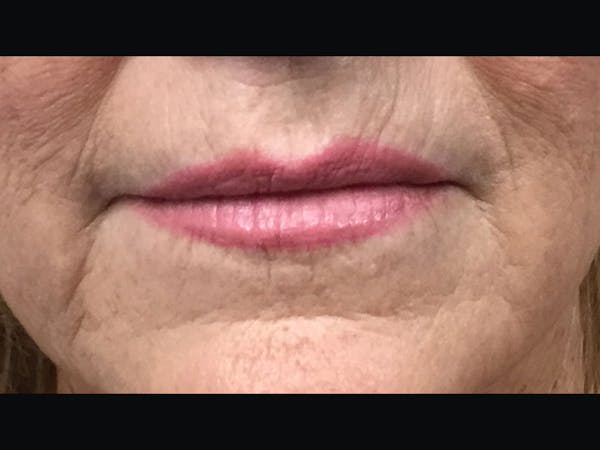 Filler Injections for Face Before & After Gallery - Patient 16689055 - Image 1