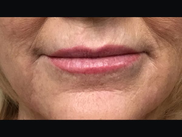 Filler Injections for Face Before & After Gallery - Patient 16689055 - Image 2