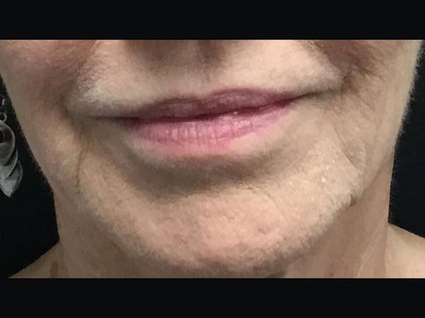Filler Injections for Face Before & After Gallery - Patient 16689056 - Image 1