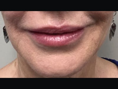 Filler Injections for Face Before & After Gallery - Patient 16689056 - Image 2